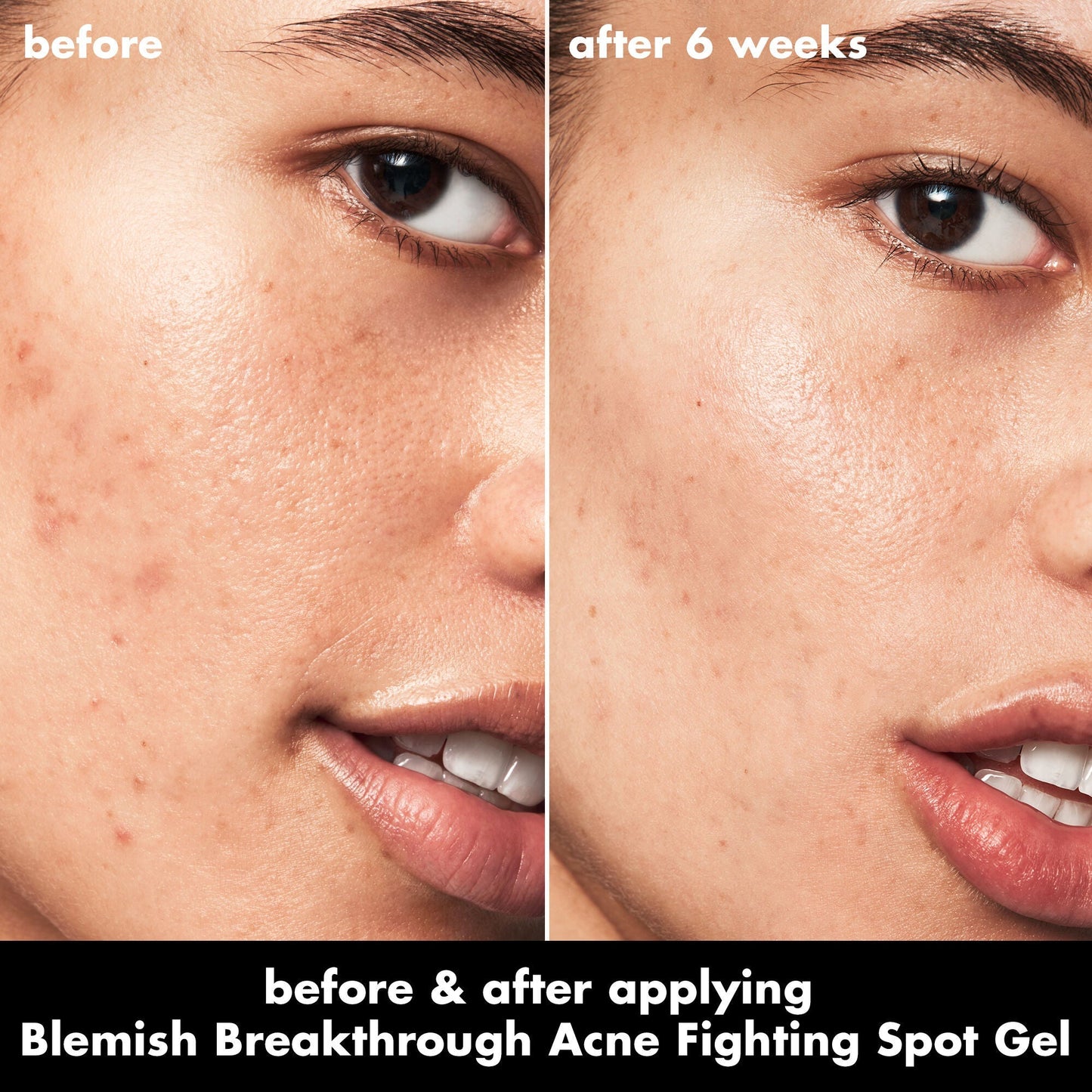 blemish-breakthrough-acne-fighting-spot-gel-a8 0326_EDU_BB_SpotGel_BA_ISABELLA.jpg