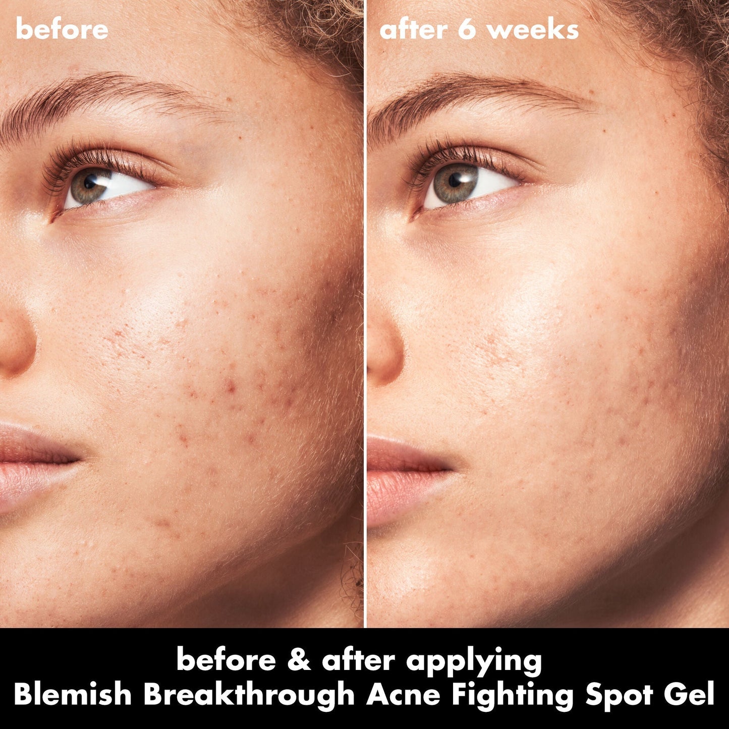 blemish-breakthrough-acne-fighting-spot-gel-a8 0326_EDU_BB_SpotGel_BA_MARLEY.jpg