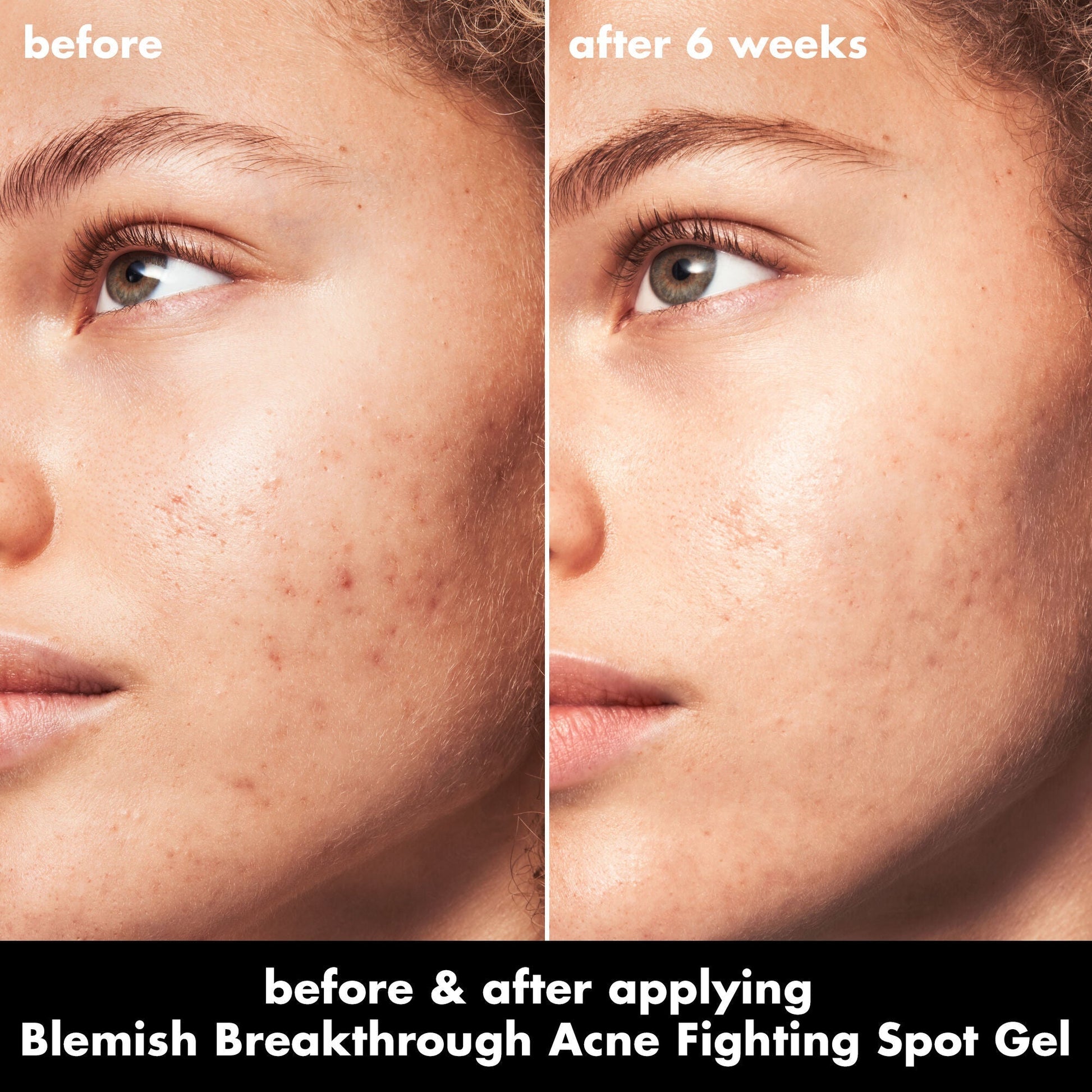 blemish-breakthrough-acne-fighting-spot-gel-a8 0326_EDU_BB_SpotGel_BA_MARLEY.jpg
