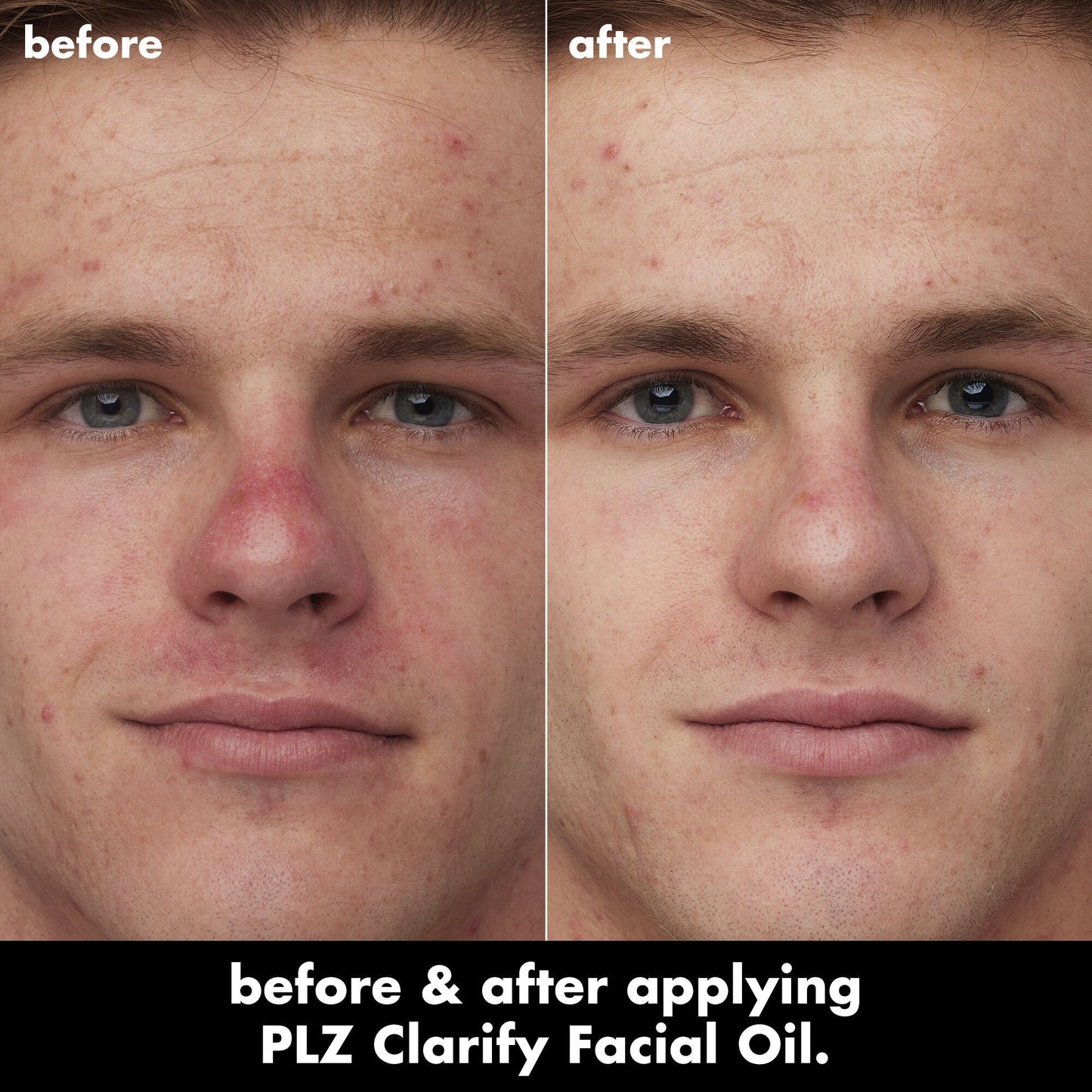 plz-clarify-facial-oil-j0 0326_EDU_PlzClarify_BA_Caleb.jpg