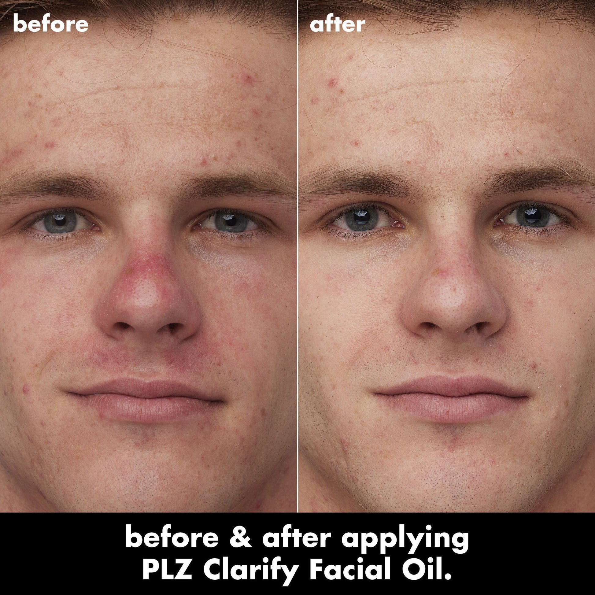 plz-clarify-facial-oil-j0 0326_EDU_PlzClarify_BA_Caleb.jpg