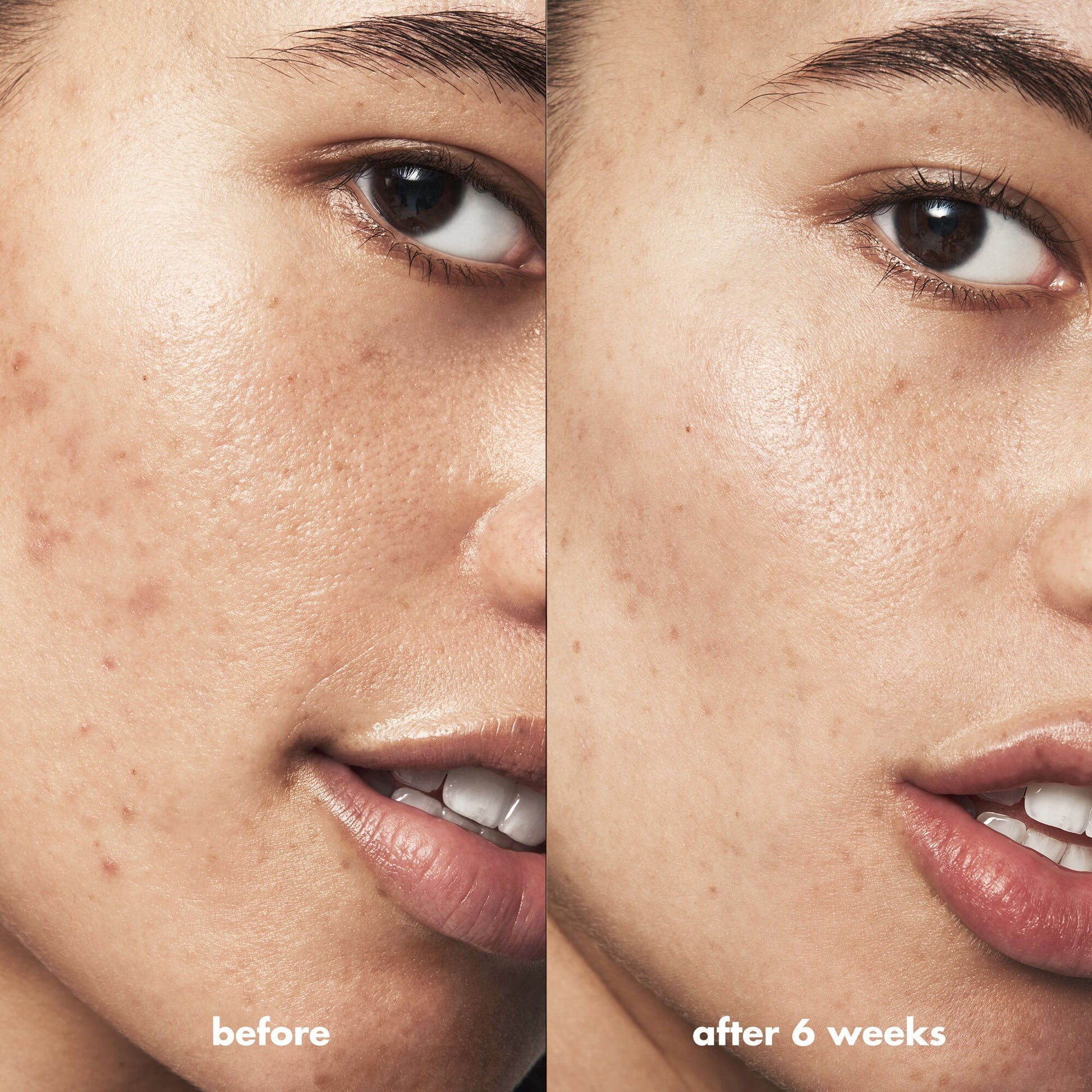 blemish-breakthrough-acne-clarifying-cleanser-d7 Acne_PDP_Isabella_Before_After_a3ff322b-cc6f-4b1a-9db3-bfb66c15d034.jpg
