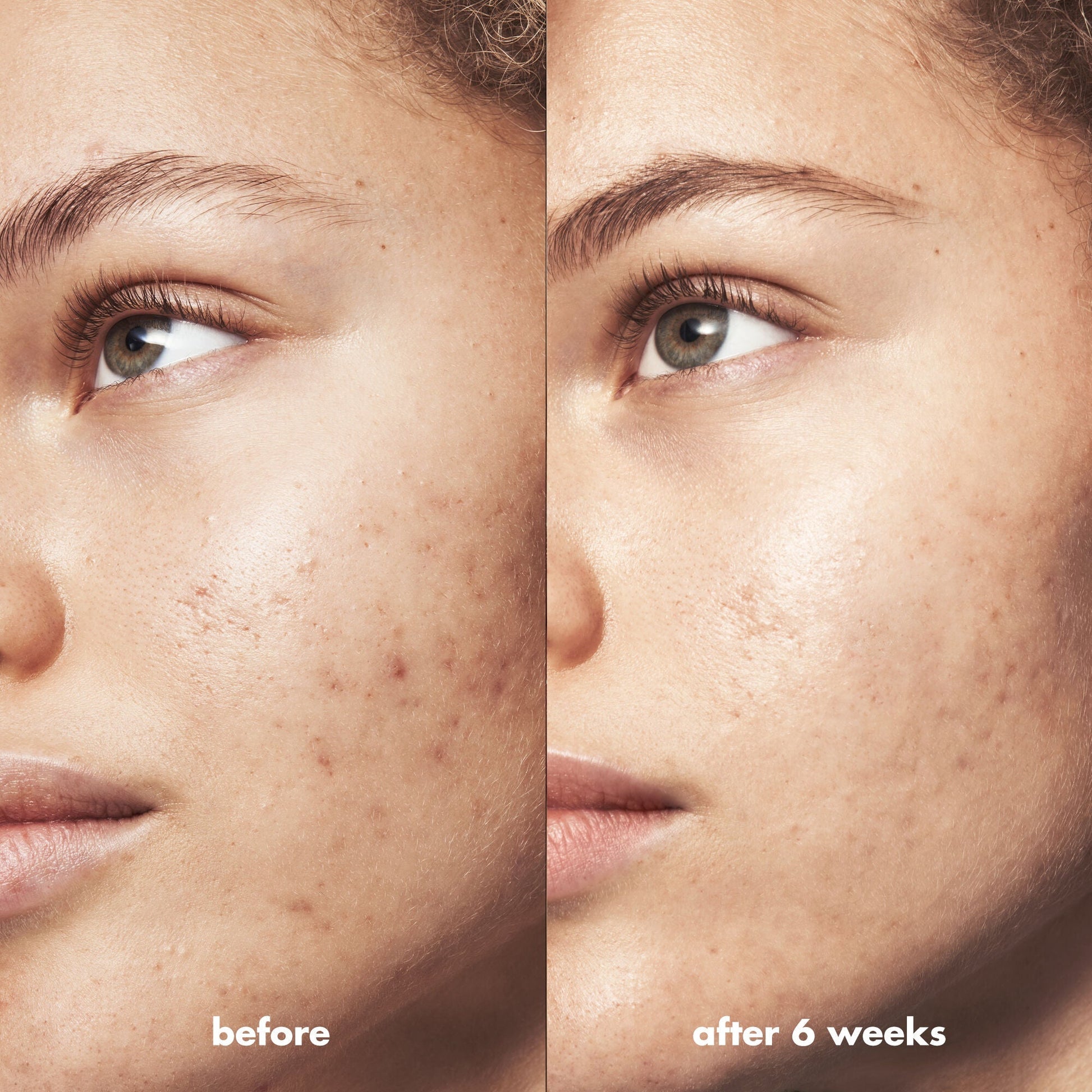 blemish-breakthrough-blemish-control-basics-kit-g2 Acne_PDP_Marley_Before_After_295728d2-6728-4f48-b8ef-c82bbca5b591.jpg
